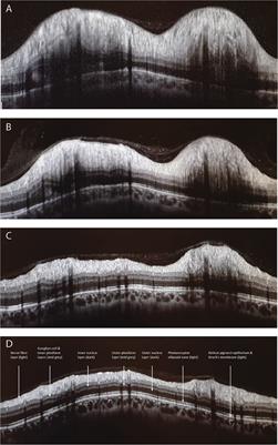 An Update on Imaging in Idiopathic Intracranial Hypertension